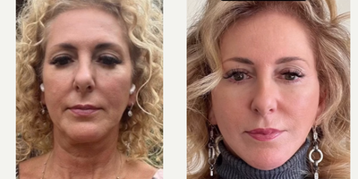 Woman treated with Neck Lift, Facelift - What can a deep plane facelift and neck lift do?A deep plane facelift can provide the most natural and long-lasting form of facial rejuvenation to todays facelift surgeon. It is considered the best facelift technique by Dr. David Harley.We use local anesthesia to perform facelift and neck lift surgery, which is the safest and most patient-friendly form of anesthesia used for elective surgery.We perform facial rejuvenation surgery exclusively, and facelift and neck lift procedures are carried out daily in the office setting.