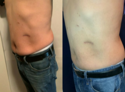 55-64 year old man treated with Emtone - 4 sessions of Emsculpt Neo and Emtone, and already seeing amazing results at 4 weeks!