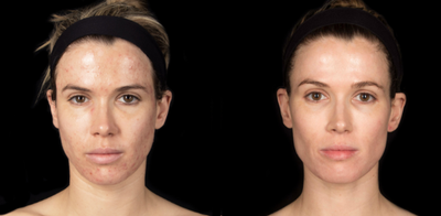 18-24 year old woman treated with Accutane - Woman treated for acne