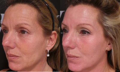 Non-surgical skin resurfacing treatment at Revere Clinics - EndyMed FSR (Fractional Skin Resurfacing) gently treats all skin layers for effective results, giving brighter skin, reducing pigmentation, improving the skin texture, smoothing out wrinkles and scars.