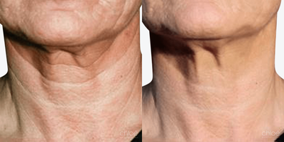 Treat Neck Laxity using Mesotherapy - The loss of collagen over the years makes the neck skin looser and more wrinkled. Our non-surgical treatments (mesotherapy) will improve collagen production and give the neck a smoother and younger appearance.