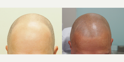 45-54 year old man treated with Scalp Micropigmentation - 45-54 year old man treated with Scalp Micropigmentation