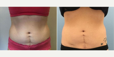 Woman treated with SculpSure - Woman treated with SculpSure.