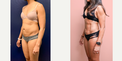 25-34 year old woman treated with Vaser Liposuction, Liposculpture, Abdominal Etching - This lovely out-of-state patient underwent liposuction by another surgeon on the West coast, but was unhappy with the result. She consulted with other providers but finally settled on having her surgery with me. She was already athletic but wanted to have definition to show the fruits of her hard work a little more, especially after her pregnancies. She is shown 1 year post-op from high-definition liposuction using Vaser to define her abdomen. She finally loves her results!