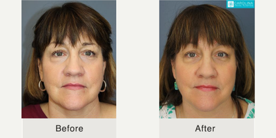 45-54 year old woman treated with Profound RF - Profound RF used to rejuvenate the lower face and neck of a female patient.