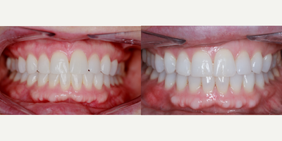 45-54 year old woman treated with InBrace - This patient came to us with some crowding and alignment issues. She decided to go with InBrace which is hidden behind the teeth and was a big concern of hers since she wanted it to go unnoticed. She was able to finish her treatment with InBrace in just 13 months!