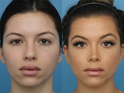 Woman treated with Rhinoplasty - Woman treated with Rhinoplasty