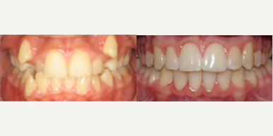 18-24 year old woman treated with Damon Braces - Damon Braces Treatment