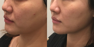 35-44 year old woman treated with Thermage FLX - age 25-34 years old woman treated with Thermage FLX on lower face