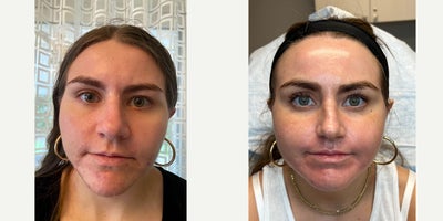 PERIORAL ACNE SCAR JOURNEY - This patient came to us after having a hormonal acne outbreak, which we helped to calm before laser treatment with skincare and peels then treated her scars that were left behind in a series of treatments. She underwent the perfect combination for her acne scars: Pixel, Halo, and the mighty CO2. Together with diligent post-treatment skin care, she was able to achieve these fantastic results. She is so much happier in her life and is receiving compliments from her friends and family almost constantly. She put in a lot of time and work in order to see this amazing improvement and she can't wait to ring in the New Year with fresh skin.