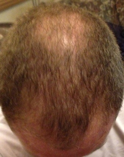 Slow growth? Or failed hair transplant? (Photo) Doctor Answers, Tips