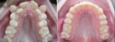 Damon Braces - 
	Patient had a narrow arch and was crowded. We used the damon system and expander to straightened teeth and widen arch.

