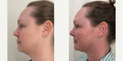 35-44 year old woman treated with Morpheus8 - Morpheus 8 face and neck.