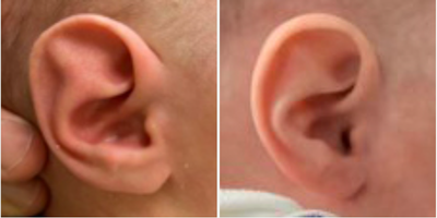 Person treated with Ear Surgery - Person treated with Ear Surgery
