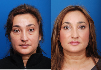 Blepharoplasty - The patient presented with concerns of a fatigued look, regardless of the amount of rest, and desired a more youthful and fresh eye appearance.