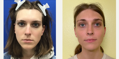 Patient treated with Cheek Augmentation - Small Combined Cheek Implants - 18 to 24 year-old female patient is 11 months post-op from Cheek Augmentation surgery. Her procedure included: Small Combined Cheek Implants.