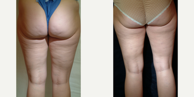 25-34 year old woman treated with Cellulaze - Grade II cellulite with one treatment of Cellulaze