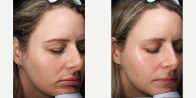 Woman treated with Fractora RF - Woman treated with Fractora RF