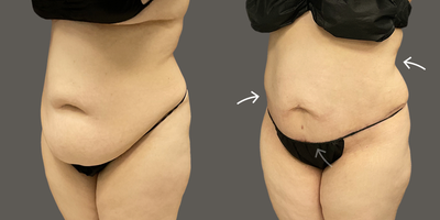 45-54 year old woman treated with AirSculpt - The patient received stomach airsculpt along with Tiny Tuck which is a small skin incision in our salt lake city location. The patient is 6 months post-op.