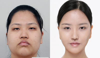 25-34 year old woman treated with Protruded Mouth Surgery, Face Lifting and Endotine Lifting - Female Patient went through Protruded Mouth Surgery + Face Lifting + Endotine Lifting. Before andafter 3 months.