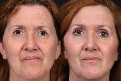Vi Peel for Skin Rejuvenation - Patient had a series of Vi Peel treatments to improve the tone and texture of her skin. She was also treated with injectables to relax wrinkles in her forehead and around her eyes, and volumize and lift cheeks.