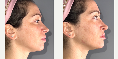25-34 year old woman treated with Chin Filler, Lip Fillers, Juvederm, Voluma, Volbella - patient treated 3 syringes of voluma in jaw and chin and .55 volbella in lips