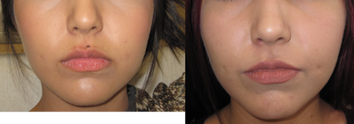 Mole removal using plastic surgery techniques - Mole removal using plastic surgery techniques