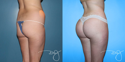 18-24 year old woman treated with Butt Augmentation - Liposuction of upper and lower and lower abdomen, flank, bra roll and  lower back with a fat transfer to buttock.