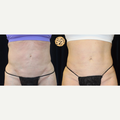 45-54 year old woman treated with Liposuction Revision - Liposuction revision using sculptra.