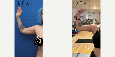 Young female treated with laser and radiofrequency awake liposuction. - This patient was referred to us from other happy patients. She wanted to decrease the size of and sculpt her arms, front bra rolls, armpit, and buffalo hump. After a thorough in person consultation, we came up with a plan that would fulfill her desires. We performed PRECISION SCULPT laser and radiofrequency assisted powered liposuction. The procedure was achieved without the need of general anesthesia. Oral medication was given to calm any nerves. Complete local anesthesia was accomplished through tiny well hidden incisions. A smart laser micro-cannula was passed through the fat for full preparation. Multiple air powered three mm diameter and smaller cannulas were guided through the excess fat. The procedure was completed in about three hours. A custom compression garment with foam pads was immediately placed at the completion of the procedure. She was back exercising in two weeks. She sent these after photos while at the gym after two months of healing.
