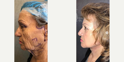 55-64 year old woman treated with Lower Face Lift - Before and after advance Mehr design full face and extended neck lift and upper eyelid surgery, laser and deep chemical skin treatment. 2 weeks post op.