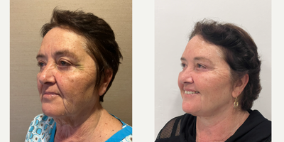 65-74 year old woman treated with Facelift, Neck Lift - deep plane lower face-necklift