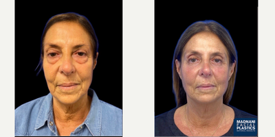 65-74 year old woman treated with Eyelid Surgery, Cheek Augmentation - 72 y.o female who was concerned with tired eye appearance and hollowness of her mid face. She underwent transconjuctival lower blepharoplasty with skin pinch and facial fat transfer of cheek, tear trough and nasolabial folds under local anesthesia. At 1 month post-op, her eye bags are completely gone and her mid face is volumized resulting in a youthful appearance.