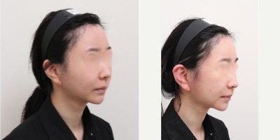 35-44 year old woman treated with AccuLift, Liposuction - 38 Years old female patientChief Complain: Face assymetry, bukly faceTreatment Plan: ACCU facial liposuctionOutcome: Smooth face line, less visible asymmetry, balanced face shape