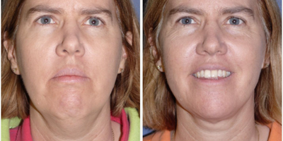 Woman treated with Liposuction - Woman treated with Chin Liposuction as well as Neck Lift and Chin Implant to address excess skin on her neck, fats and neck muscle (platysma) for a profound change in neck and chin area.