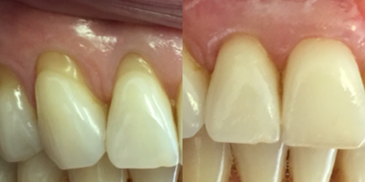 35-44 year old woman treated with Gum Lift - Gum Lift