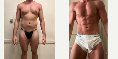 Gladiator Lipo with Renuvion & Fat Grafting - High-definition Gladiator Lipo with Renuvion tightening of the torso and chest. Fat grafting enhanced the chest and buttocks, while a nipple lift and gland removal created a more sculpted, masculine contour.