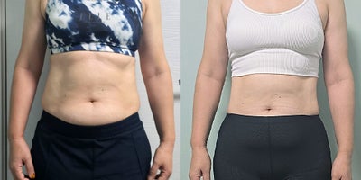 45-54 year old woman treated with Lipodissolve - Fat-dissolving injections to contour the abdominal area