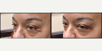 45-54 year old woman treated with Cyst Removal, Eyelid Surgery - Hidrocystoma (fluid cyst) removal from eyelids