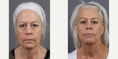 Woman treated with Deep Plane Facelift, Facelift, Neck Lift, Facial Fat Transfer, Eyelid Surgery - Facial RejuvenationOur patient achieved remarkable results with:Deep Plane Face & Neck LiftLower BlepharoplastyFat Transfer