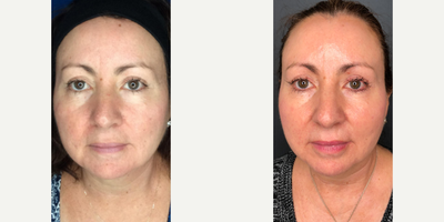 Vampire Facelift (PRP Facial) for This 51 Year Old Woman - This 51-year old woman had 2 platelet-rich plasma (PRP) facial treatments to rejuvenate her skin for a more youthful appearance.
