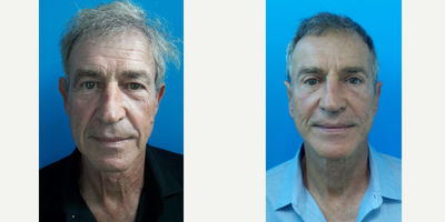 65-74 year old man treated with MACS Facelift - macslift facelift , necklift, eyelid surgery superior and inferior