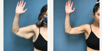 25-34 year old woman treated with Arm Lift - Patient had an Arm Lift also known as Brachioplasty