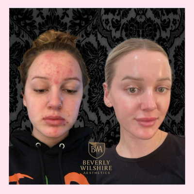 18-24 year old woman treated with Microneedling, HydraFacial, VI Peel - This client underwent a customized series of chemical peels, HydraFacials, and microneedling at Beverly Wilshire Aesthetics. The combination approach calmed active acne, improved skin tone, and rebuilt collagen for smoother texture. Results shown here demonstrate a dramatic reduction in breakouts and redness, with clear, radiant skin now revealed.