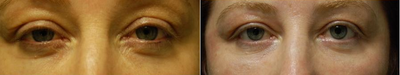 Madonna Lift one week after Smartskin for upper and lower lid wrinkles - 	This patient is one week post Madonna lift, intended to open the eyes and soften fine wrinkling. Three treatments at 3-4 week intervals are recommended. The patient was able to go to work with a little make-up on the third day. Treatment on a Thursday or Friday, return to work on Monday. Appearance will improve after each treatment with minimal down-time.