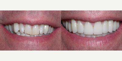 65-74 year old man treated with Da Vinci Veneers - Patient didn't like the way his teeth were shaped and how they looked like they slanted to his left. After completing ten veneers and reshaping his lower teeth.