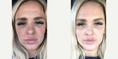 18-24 year old woman treated with Dermaplaning - The patient was treated with dermaplaning and a chemical peel. See the improvement in complexion and texture! #Glowing