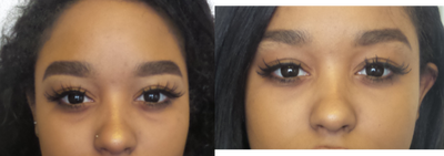25-34 year old woman treated with Volbella - This patient received Volbella filler treatment to address dark circles and lost volume under her eyes.