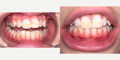 18-24 year old woman treated with BriteSmile - Whitening procedure