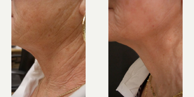 Woman treated with Intracel - Woman treated with Intracel